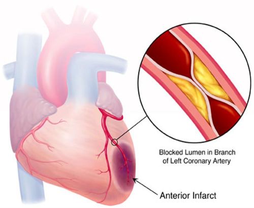 mỡ máu có mối liên hệ chặt chẽ với tim mạch