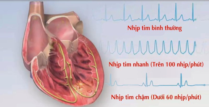 thiếu máu dẫn đến rối loạn nhịp tim